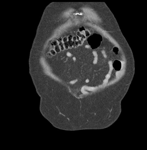 Adult ileal intussusception with secondary obstruction (Radiopaedia 30395-31051 Coronal C+ portal venous phase 9).jpg