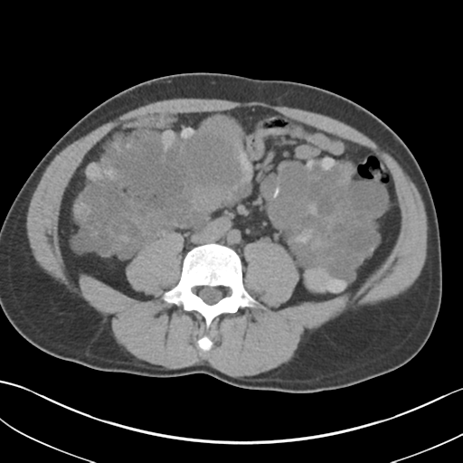 File:Adult polycystic kidney disease (Radiopaedia 47866-52626 Axial non-contrast 47).png