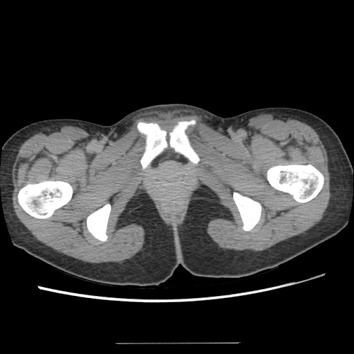 Adult polycystic kidney disease (Radiopaedia 48845-53876 Axial renal excretory phase 100).jpg