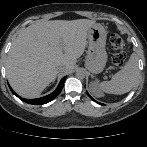 Adult polycystic kidney disease (Radiopaedia 59075-66368 Axial non-contrast 5).jpg