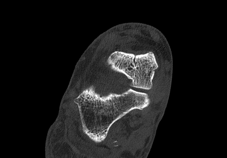 File:Advanced osteomyelitis due to open metatarsal fracture (Radiopaedia 83891-99095 Axial bone window 11).jpg