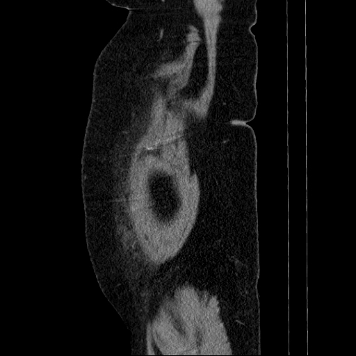 File:Afferent loop syndrome - secondary to incarcerated trocar site hernia (Radiopaedia 82959-97305 Sagittal C+ portal venous phase 147).jpg