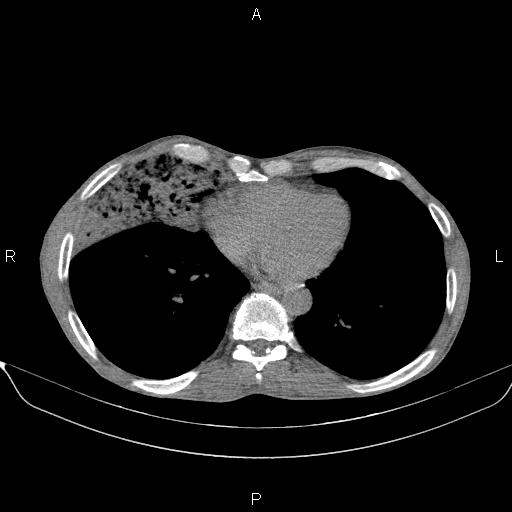 File:Air bronchogram in pneumonia (Radiopaedia 85719-101512 Axial non-contrast 47).jpg