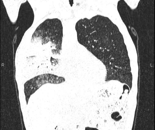 Air bronchogram in pneumonia (Radiopaedia 85719-101512 Coronal lung window 19).jpg