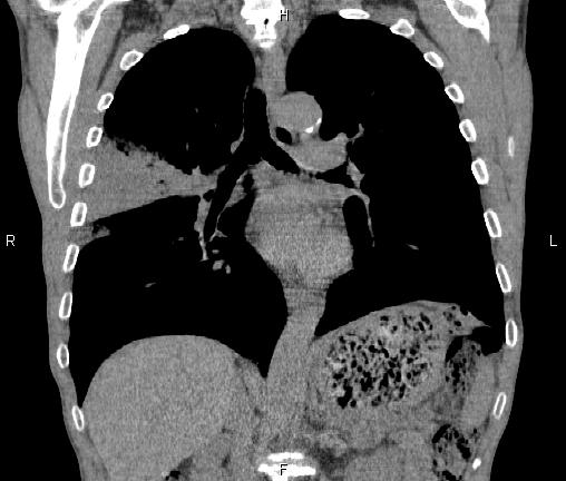 File:Air bronchogram in pneumonia (Radiopaedia 85719-101512 Coronal non-contrast 32).jpg