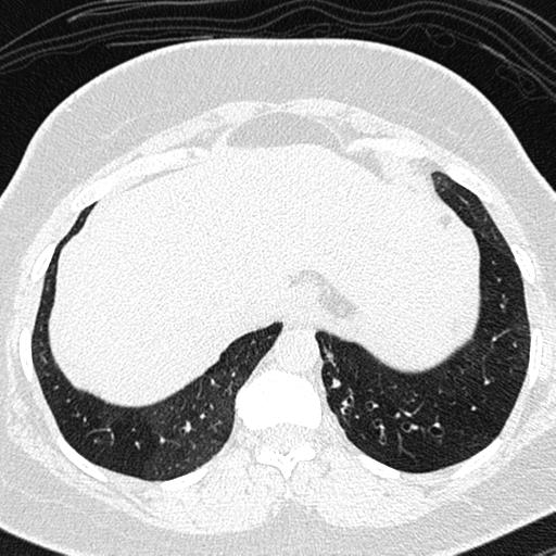 Air trapping in small airway disease (Radiopaedia 61685-69694 Axial lung window 165).jpg
