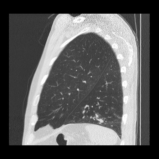 Allergic bronchopulmonary aspergillosis (ABPA) (Radiopaedia 60594-68313 Sagittal lung window 11).jpg