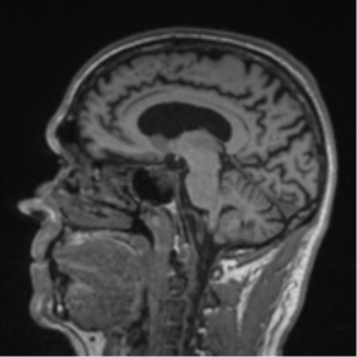 Alzheimer's disease- with Gerstmann syndrome and dressing apraxia (Radiopaedia 54882-61150 Sagittal T1 40).png