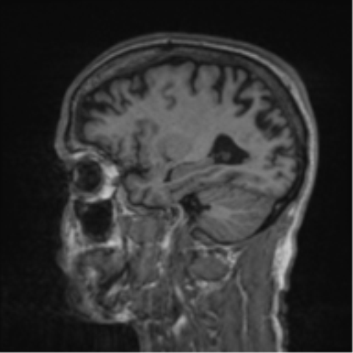 File:Alzheimer's disease- with apraxia (Radiopaedia 54763-61011 Sagittal T1 50).png