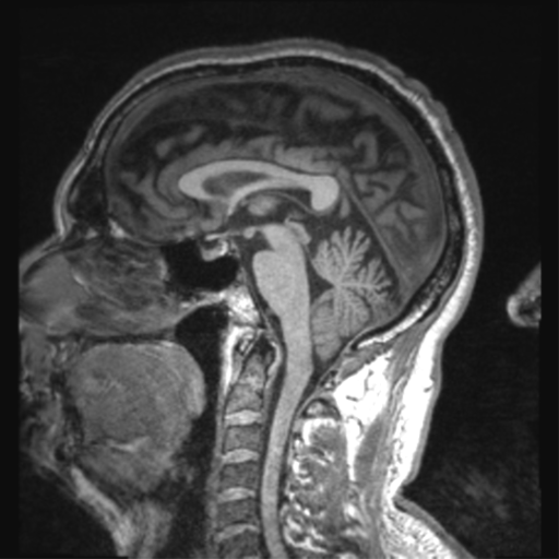 Alzheimer disease - probable (Radiopaedia 35334-36837 Axial T1 74).png