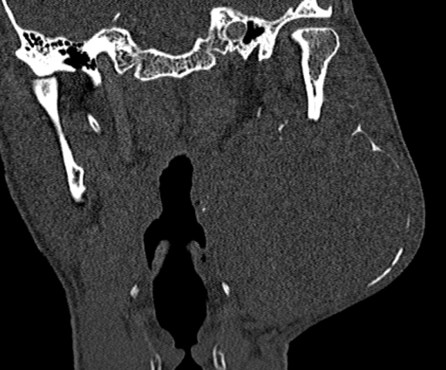 Ameloblastoma (Radiopaedia 51921-57766 Coronal bone window 184).jpg