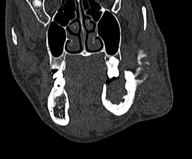Ameloblastoma (Radiopaedia 51921-57766 Coronal bone window 89).jpg