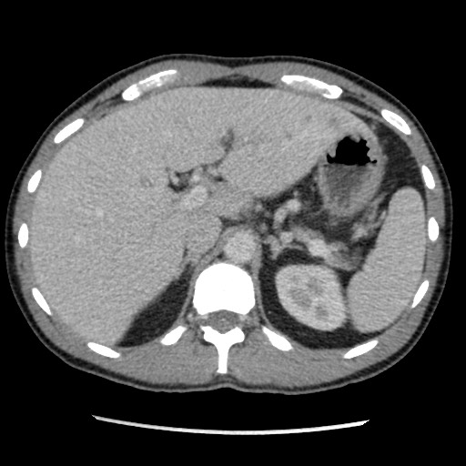 Amoebic liver abscesses (Radiopaedia 55536-62009 A 27).jpg