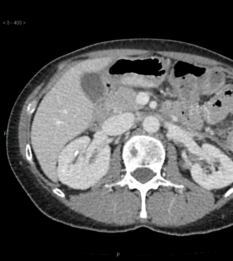 Ampulla of Vater metastasis (Radiopaedia 27820-28065 A 7).jpg