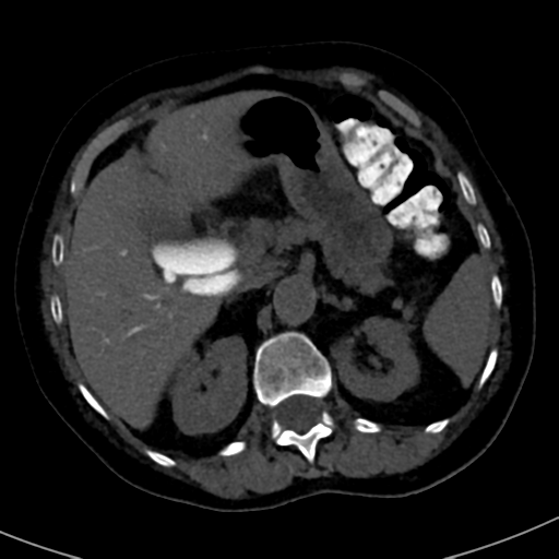 File:Ampullary adenocarcinoma (Radiopaedia 34013-35241 AXIAL THICK 25).png