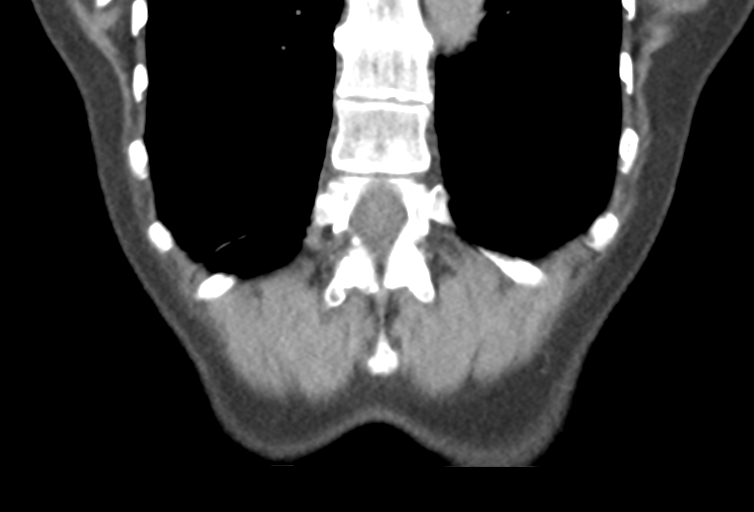 Ampullary adenocarcinoma (Radiopaedia 34013-35241 Coronal 46).png