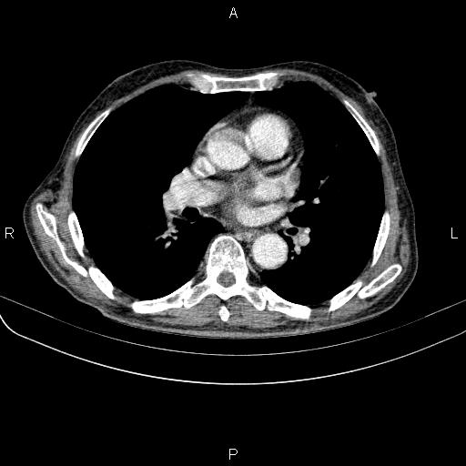 Ampullary adenocarcinoma (Radiopaedia 86093-102033 B 34).jpg