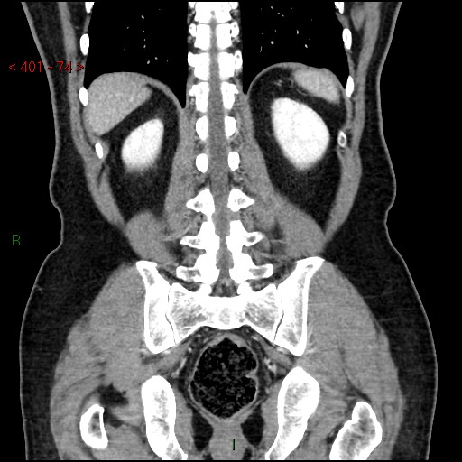 Ampullary carcinoma (Radiopaedia 56396-63056 E 73).jpg