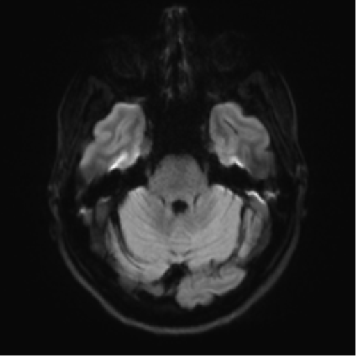 Anaplastic astrocytoma - thalamic glioma (Radiopaedia 59709-67115 Axial DWI 45).png