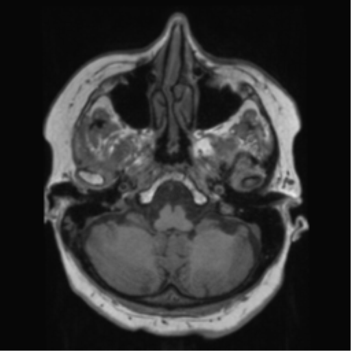 File:Anaplastic astrocytoma IDH wild-type (pseudoprogression) (Radiopaedia 42209-45278 Axial T1 40).png