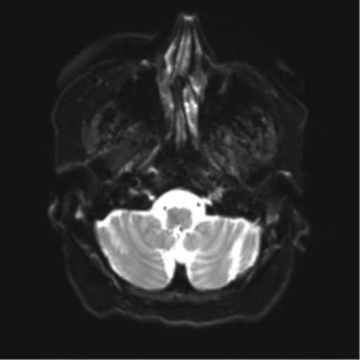 Anaplastic astrocytoma IDH wild-type (pseudoprogression) (Radiopaedia 42209-45279 Axial DWI 4).png