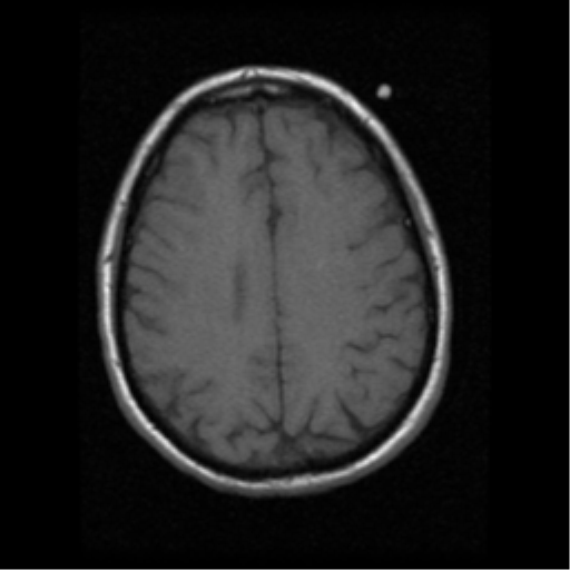 File:Anaplastic meningioma with recurrence (Radiopaedia 34452-35783 Axial T1 15).png