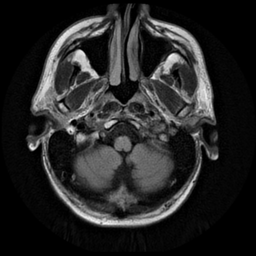 File:Anaplastic meningioma with recurrence (Radiopaedia 34452-35791 Axial FLAIR 2).png