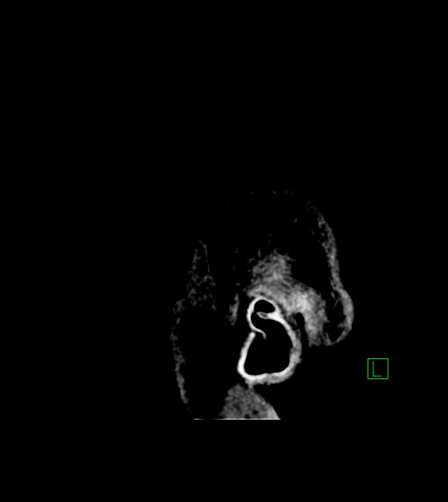 Anaplastic oligodendroglioma (Radiopaedia 79571-92753 C 4).jpg