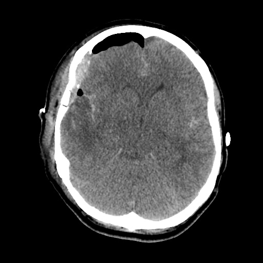 Aneursym related subarachnoid hemorrhage with hydrocephalus (Radiopaedia 45105-49085 Axial non-contrast 20).jpg