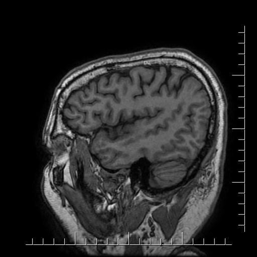 File:Aneurysm of posterior communicating artery (Radiopaedia 20188-20163 Sagittal T1 14).jpg