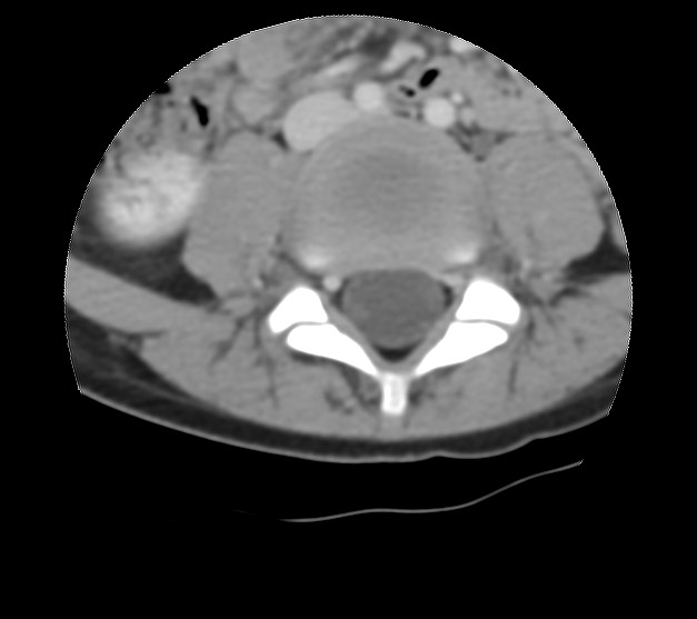 File:Aneurysmal bone cyst - sacrum (Radiopaedia 65190-74195 Axial non-contrast 5).jpg