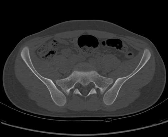 File:Aneurysmal bone cyst of ischium (Radiopaedia 25957-26094 Axial bone window 21).png