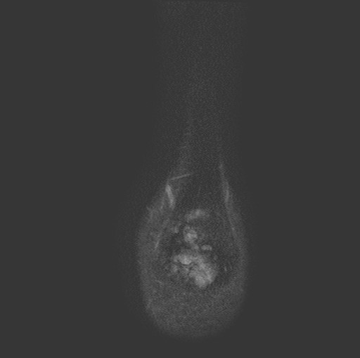 File:Aneurysmal bone cyst of the calcaneus (Radiopaedia 60669-68420 Coronal T2 fat sat 26).jpg