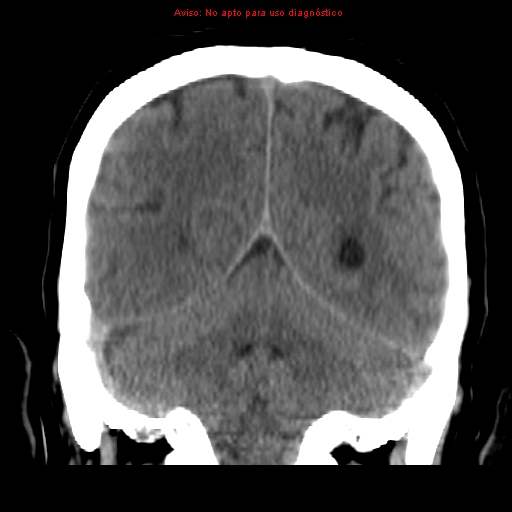 File:Aneurysmal subarachnoid hemorrhage (Radiopaedia 24740-24997 Coronal non-contrast 35).jpg