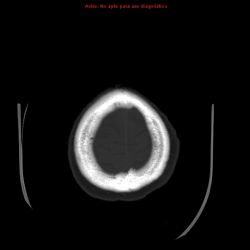 File:Aneurysmal subarachnoid hemorrhage (Radiopaedia 24740-24997 bone window 33).jpg