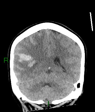 Aneurysmal subarachnoid hemorrhage with intra-axial extension (Radiopaedia 84371-99699 Coronal non-contrast 26).jpg