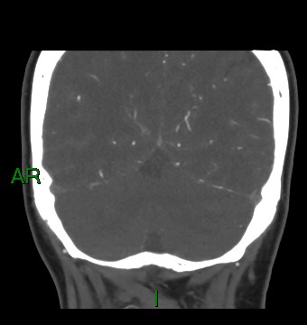 Aneurysmal subarachnoid hemorrhage with intra-axial extension (Radiopaedia 84371-99732 C 27).jpg