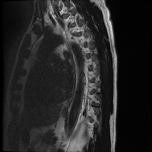 File:Angiolipoma - thoracic spine (Radiopaedia 28242-28479 Sagittal T2 1).jpg