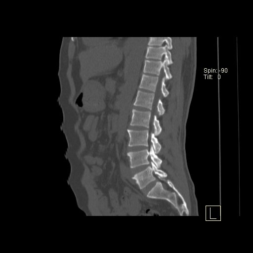 File:Ankylosing spondylitis (Radiopaedia 52728-58645 Sagittal bone window 7).jpg