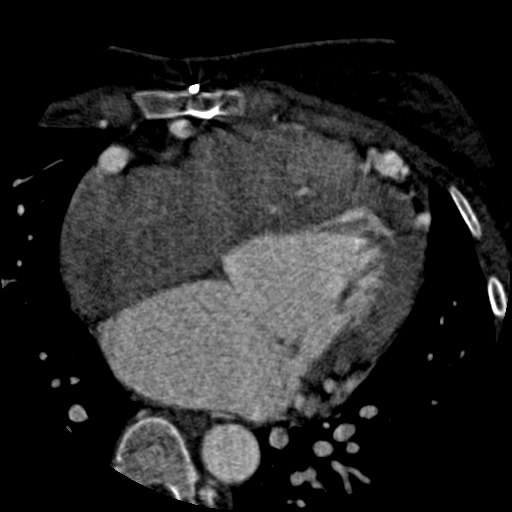 Anomalous left coronary artery from the pulmonary artery (ALCAPA) (Radiopaedia 40884-43586 A 41).jpg