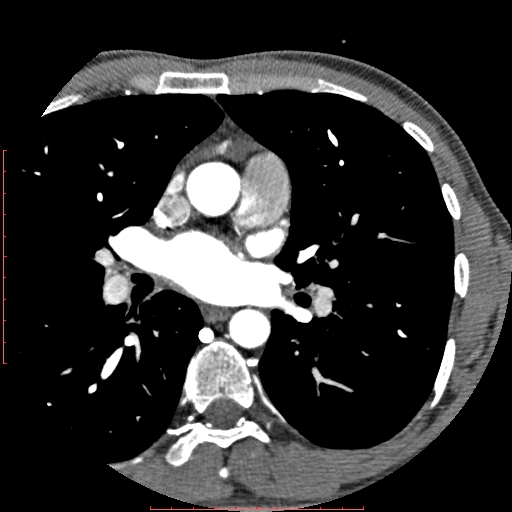 File:Anomalous left coronary artery from the pulmonary artery (ALCAPA) (Radiopaedia 70148-80181 A 52).jpg