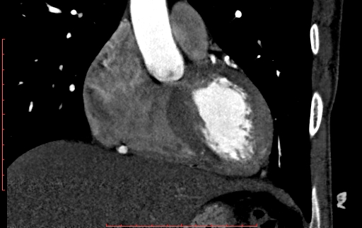 Anomalous left coronary artery from the pulmonary artery (ALCAPA) (Radiopaedia 70148-80181 B 114).jpg
