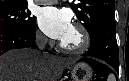 Anomalous left coronary artery from the pulmonary artery (ALCAPA) (Radiopaedia 70148-80181 B 178).jpg
