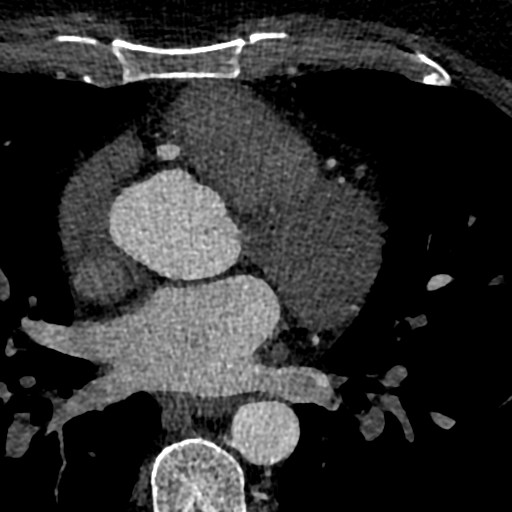 File:Anomalous origin of the left coronary artery with malignant course (Radiopaedia 77842-90126 C 72).jpeg