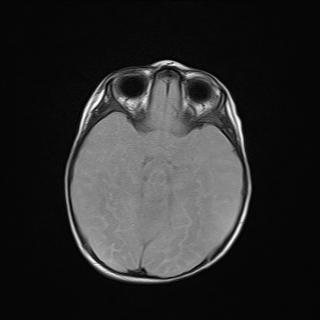 File:Anoxic brain injury (Radiopaedia 79165-92139 Axial FLAIR 11).jpg