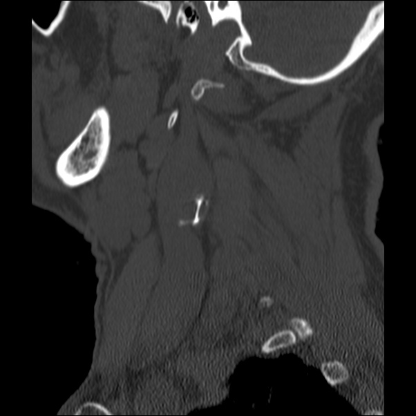 Anterior cervical postdiscectomy arthrodesis (Radiopaedia 32678-33646 Sagittal bone window 4).jpg