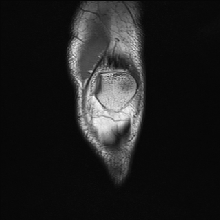 File:Anterior cruciate ligament full thickness tear (Radiopaedia 66268-75467 Coronal T1 3).jpg