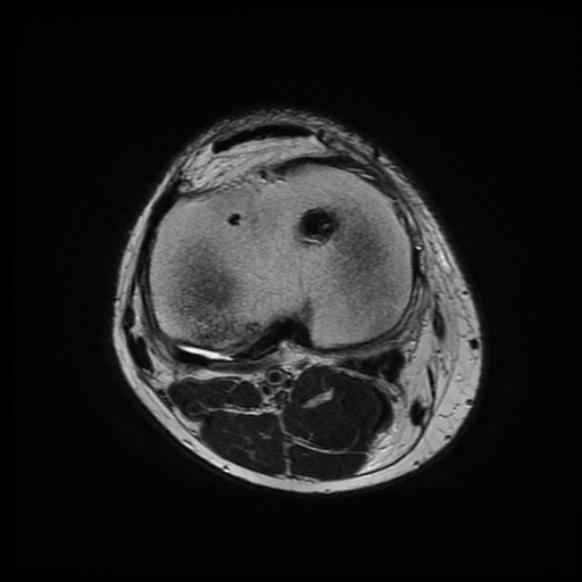 File:Anterior cruciate ligament graft tear and bucket-handle tear of medial meniscus (Radiopaedia 75867-87255 Axial T2 6).jpg