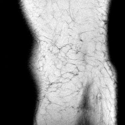 Anterior cruciate ligament mucoid degeneration (Radiopaedia 60853-68633 Sagittal T1 56).jpg