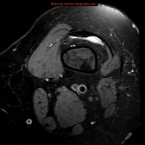 File:Anterior cruciate ligament tear (Radiopaedia 12329-12612 Axial T2 fat sat 25).jpg